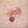 http://tbn0.google.com/images?q=tbn:96h-Ibt18OrDFM:http://at-risc.org/images/Melanoma.jpg